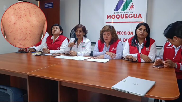 Sarampión ilo